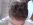 Postupn� pr�b�h alopecie