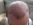 Osobn� zku�enosti a v�sledky s transplantac� vlas�