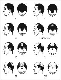 Norwood scale